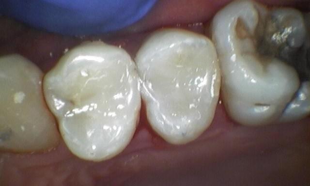 Restored tooth with fillings | Springs Family Dental | Colorado Springs, CO