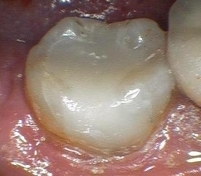 Broken Tooth Fixed With Composite Filling | cosmetic dentist colorado springs