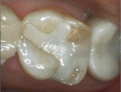 dental bonding on molars