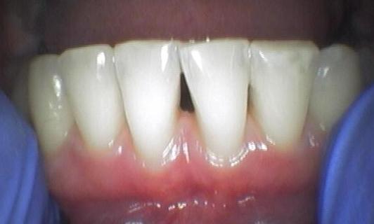 Bioclear before