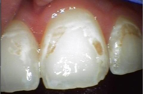 Cosmetic-Bonding-to-repair-enamel-Before-Image