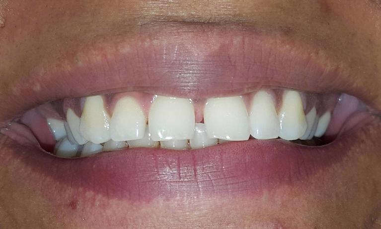 white teeth with gaps throughout smile