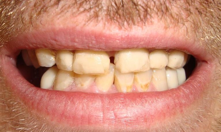 Stained, crooked teeth | cosmetic dentist colorado springs 