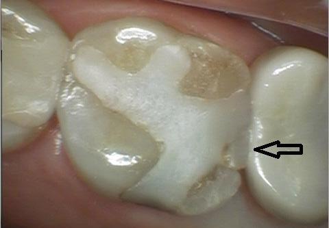 arrow pointing to a missing filling