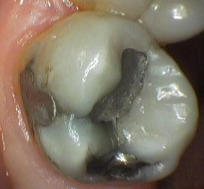 Leaking Old Metal Filling On Molar | cosmetic dentist colorado springs