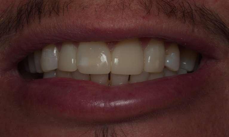 Bonding-Gaps-with-Bioclear-After-Image