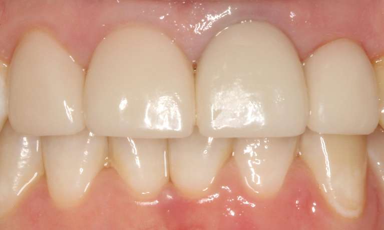 Ceramic-Crowns-After-Image