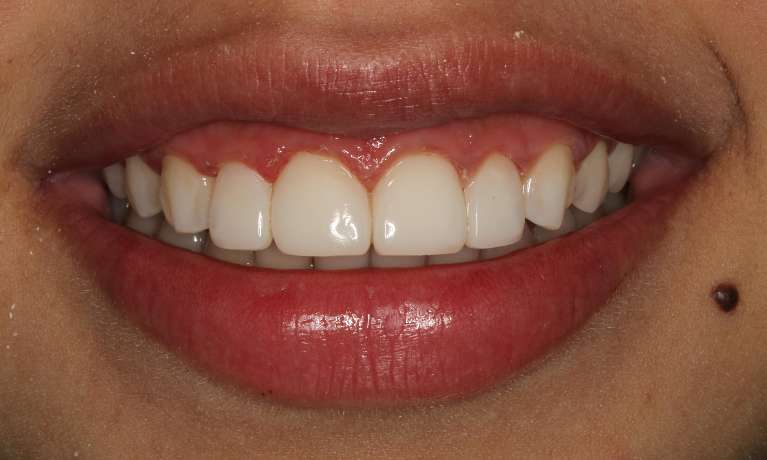 Patient's teeth after dental bonding in Colorado Springs, CO 
