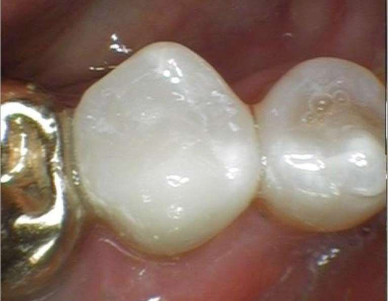 Colorado Springs Fillings- After