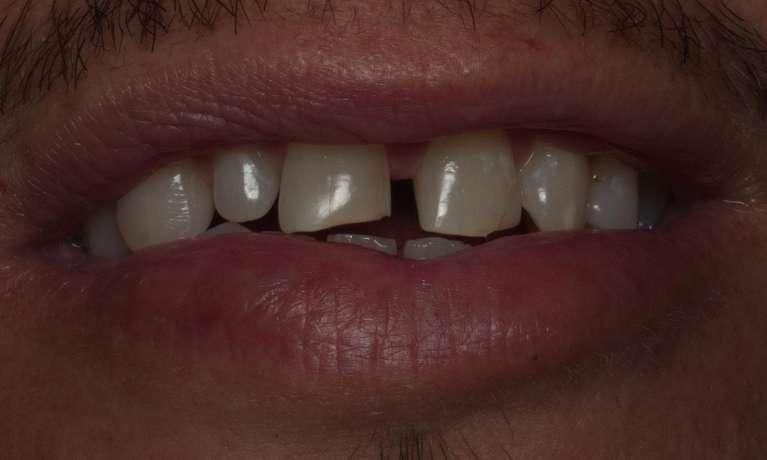 Bonding-Gaps-with-Bioclear-Before-Image