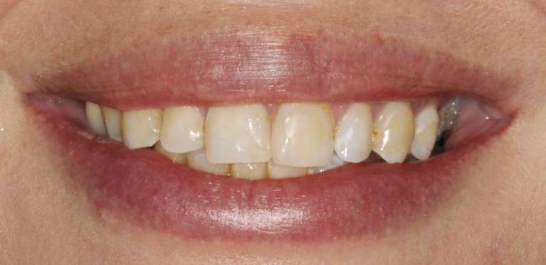 Ceramic-Veneers-and-Crowns-Before-Image