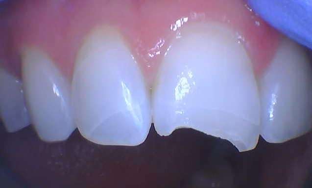 Chipped-tooth-repair-Before-Image