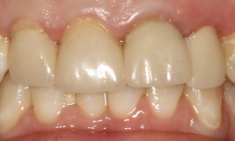 Ceramic-Crowns-Before-Image