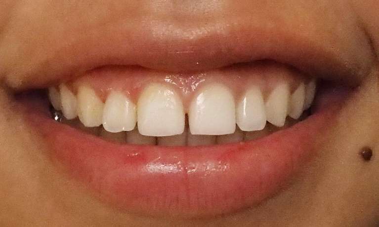 Patient's teeth before dental bonding in Colorado Springs, CO 