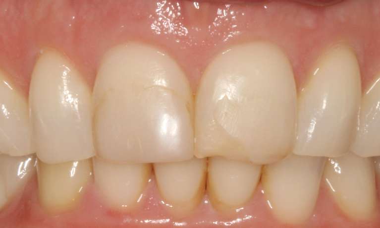a before photo of Cosmetic Bonding at Springs Family Dental