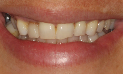 Colorado Springs Smile Makeover- Before photo